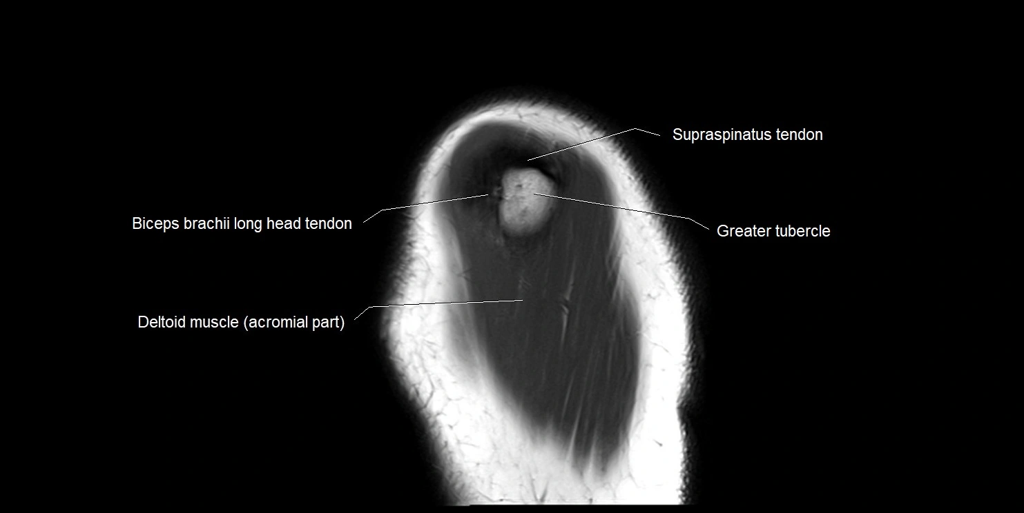 mri shoulder sagittal cross sectional anatomy image 18.webp